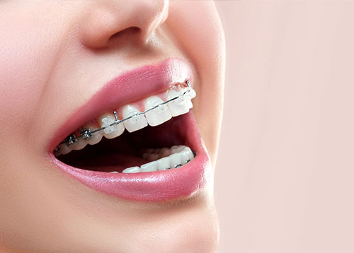 Teeth wire deals