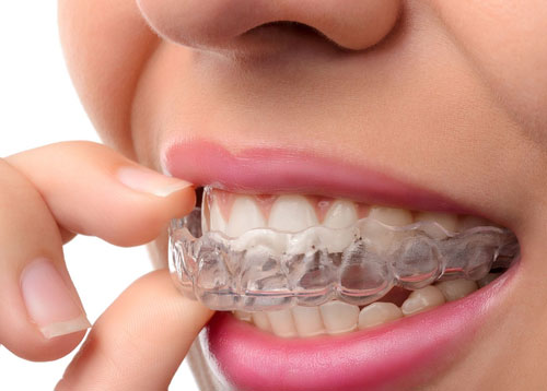 Invisalign<sup>®</sup>