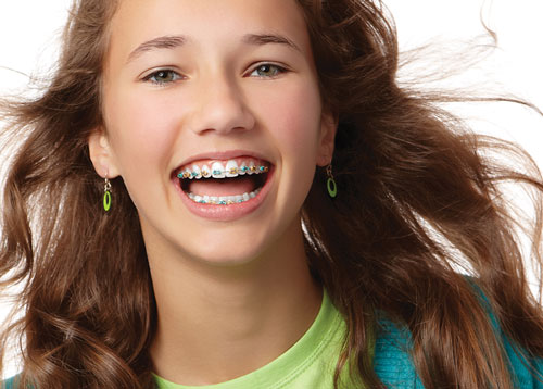 Invisalign braces