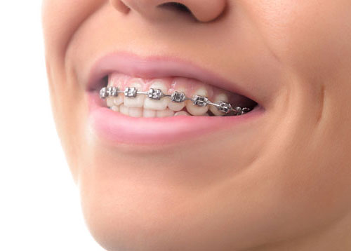 Self-Ligating Braces